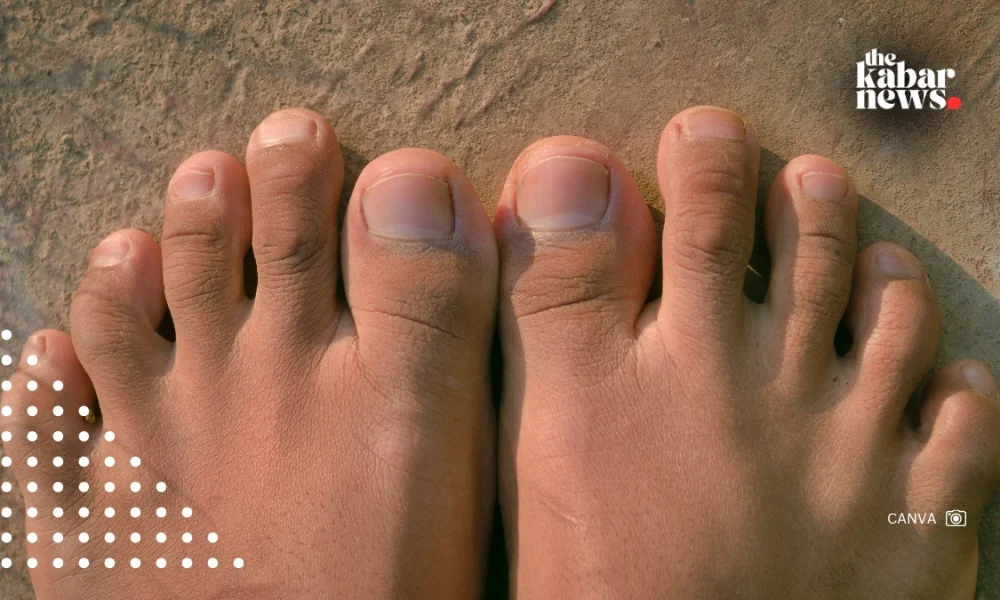 Is your second toe longer than your first? You may have Morton’s toe
