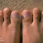 Is your second toe longer than your first? You may have Morton’s toe